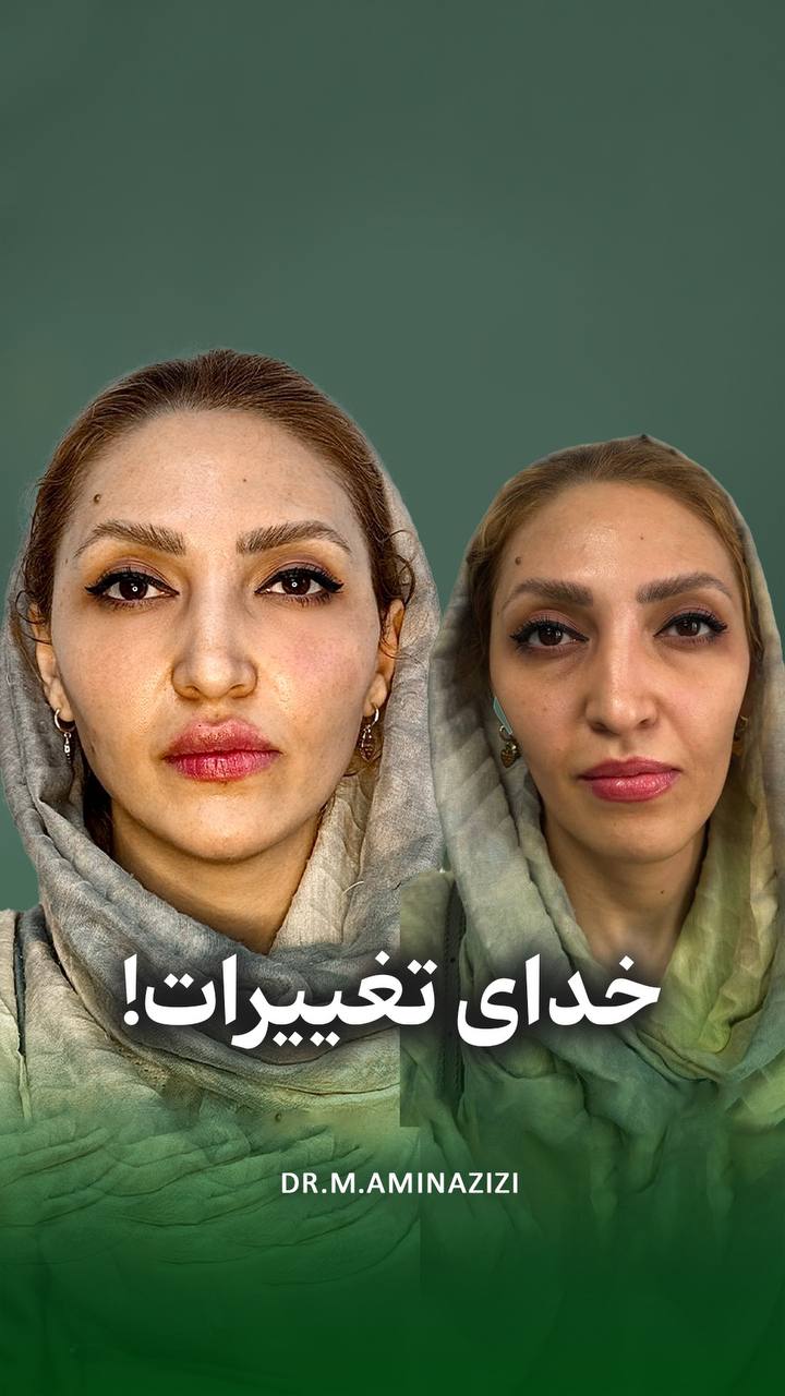 کانتورینگ صورت