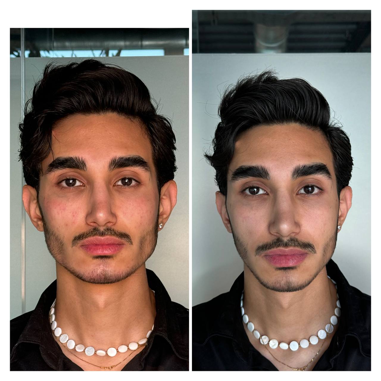face frame remodeling