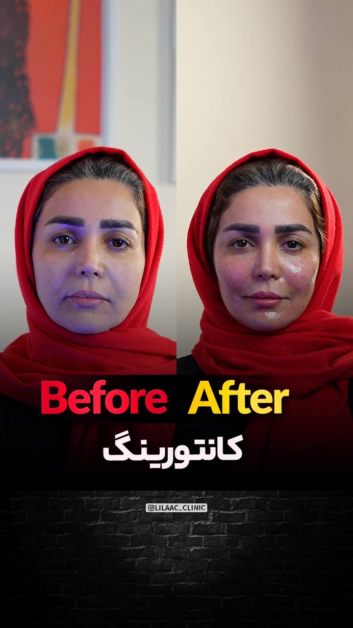 کانتورینگ صورت