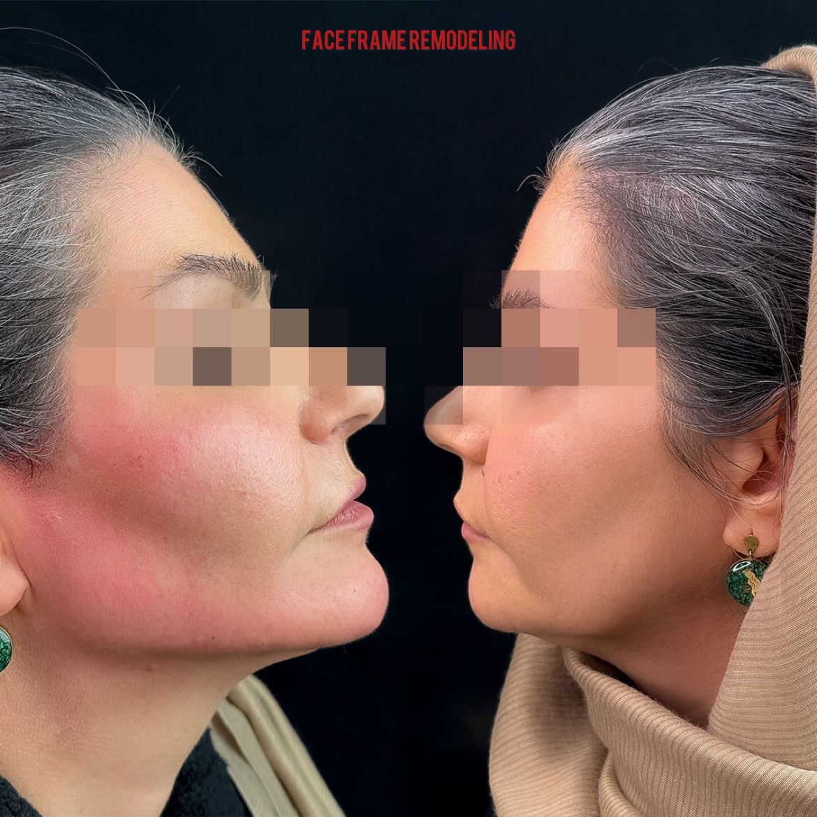 face frame remodeling